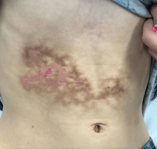 男孩每天抱电脑8小时 患上罕见“烤皮肤综合征”
