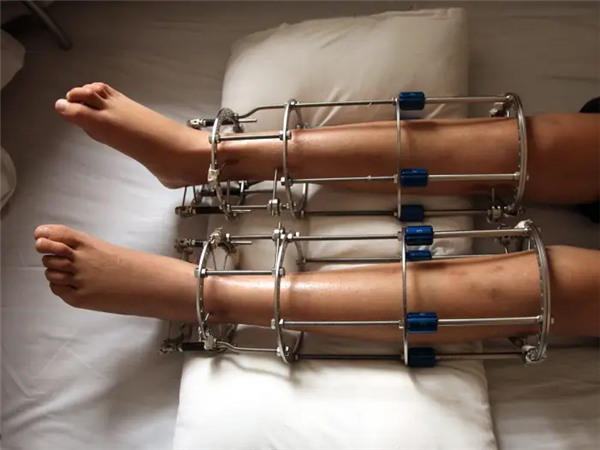 Too Crazy! Disliking being too tall for finding a partner， woman undergoes bone cutting surgery to become shorter