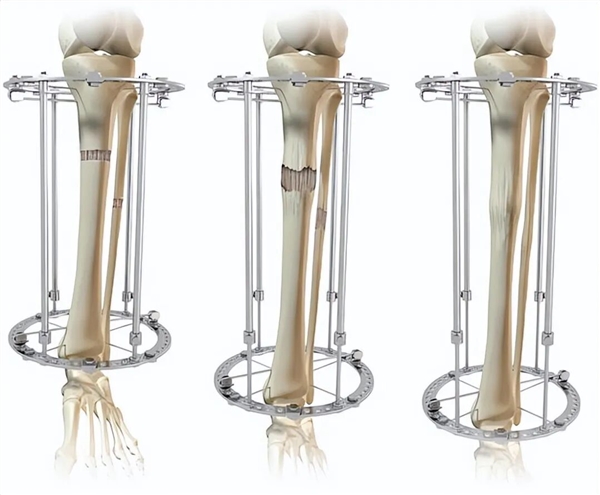 Too Crazy! Disliking being too tall for finding a partner， woman undergoes bone cutting surgery to become shorter