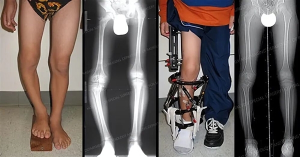 Too Crazy! Disliking being too tall for finding a partner， woman undergoes bone cutting surgery to become shorter