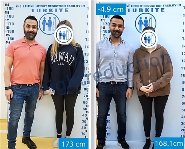 Too Crazy! Disliking being too tall for finding a partner， woman undergoes bone cutting surgery to become shorter