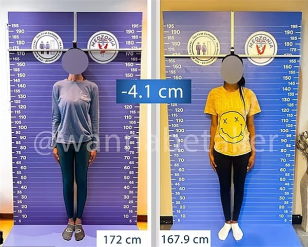 Too Crazy! Disliking being too tall for finding a partner， woman undergoes bone cutting surgery to become shorter