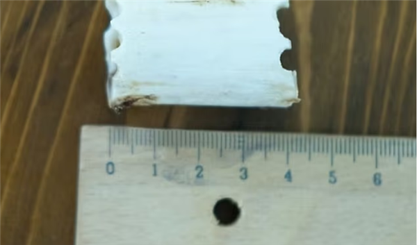 Too Crazy! Disliking being too tall for finding a partner， woman undergoes bone cutting surgery to become shorter