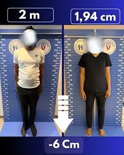 Too Crazy! Disliking being too tall for finding a partner， woman undergoes bone cutting surgery to become shorter